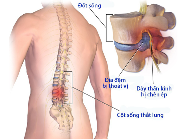 Ngồi nhiều bị đau lưng dưới: Nguyên nhân và giải pháp hiệu quả