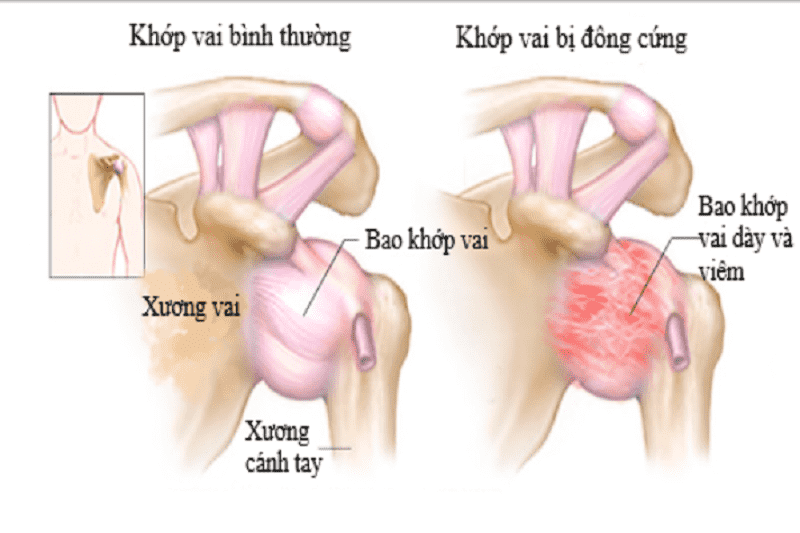 Gọt xương vai: Điều gì cần biết về quy trình và lưu ý quan trọng